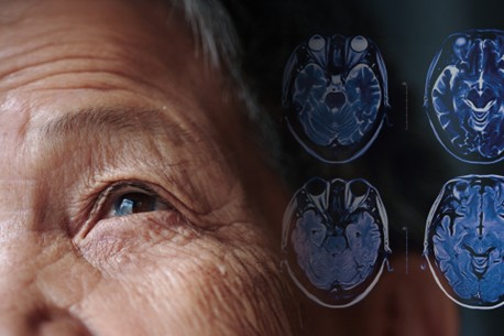 P505 - Párkinson a través del diagnósito Visual